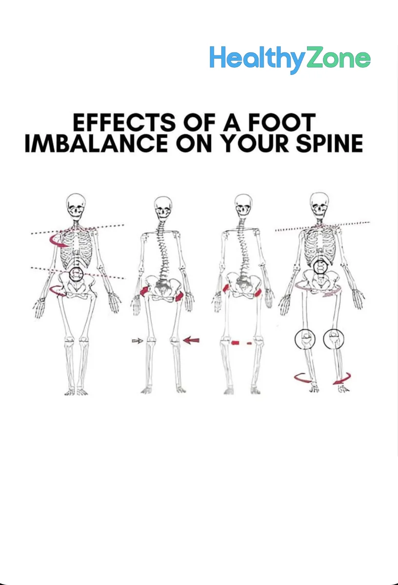 HealthyZone diagram showing the effects of a foot imbalance on the spine