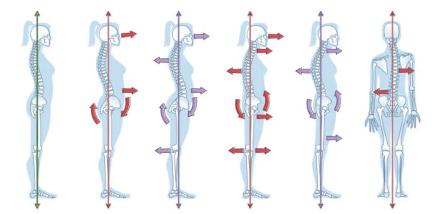 Side-view diagrams of common posture patterns and how the body compensates